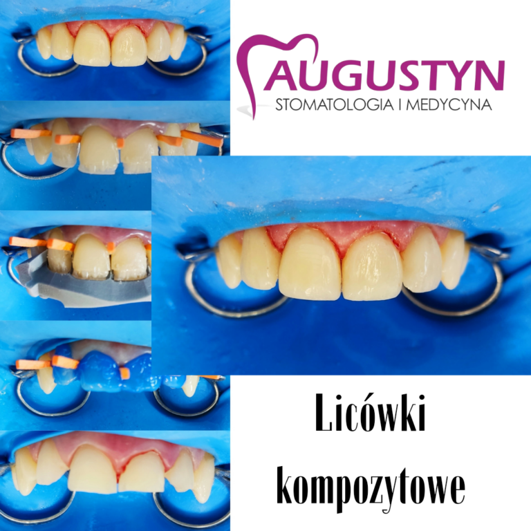 Licówki kompozytowe czyli bonding