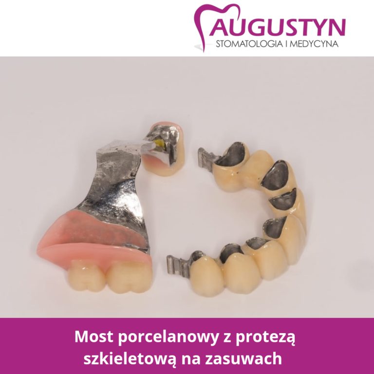 most porcelanowy z protezą