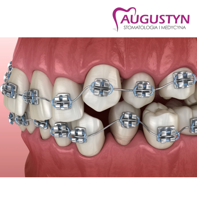 Aparat ortosontyczny stały Krapkowice