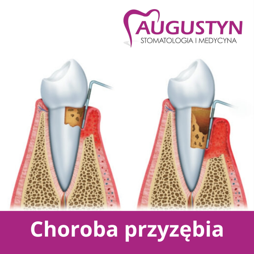 Choroba przyzębia