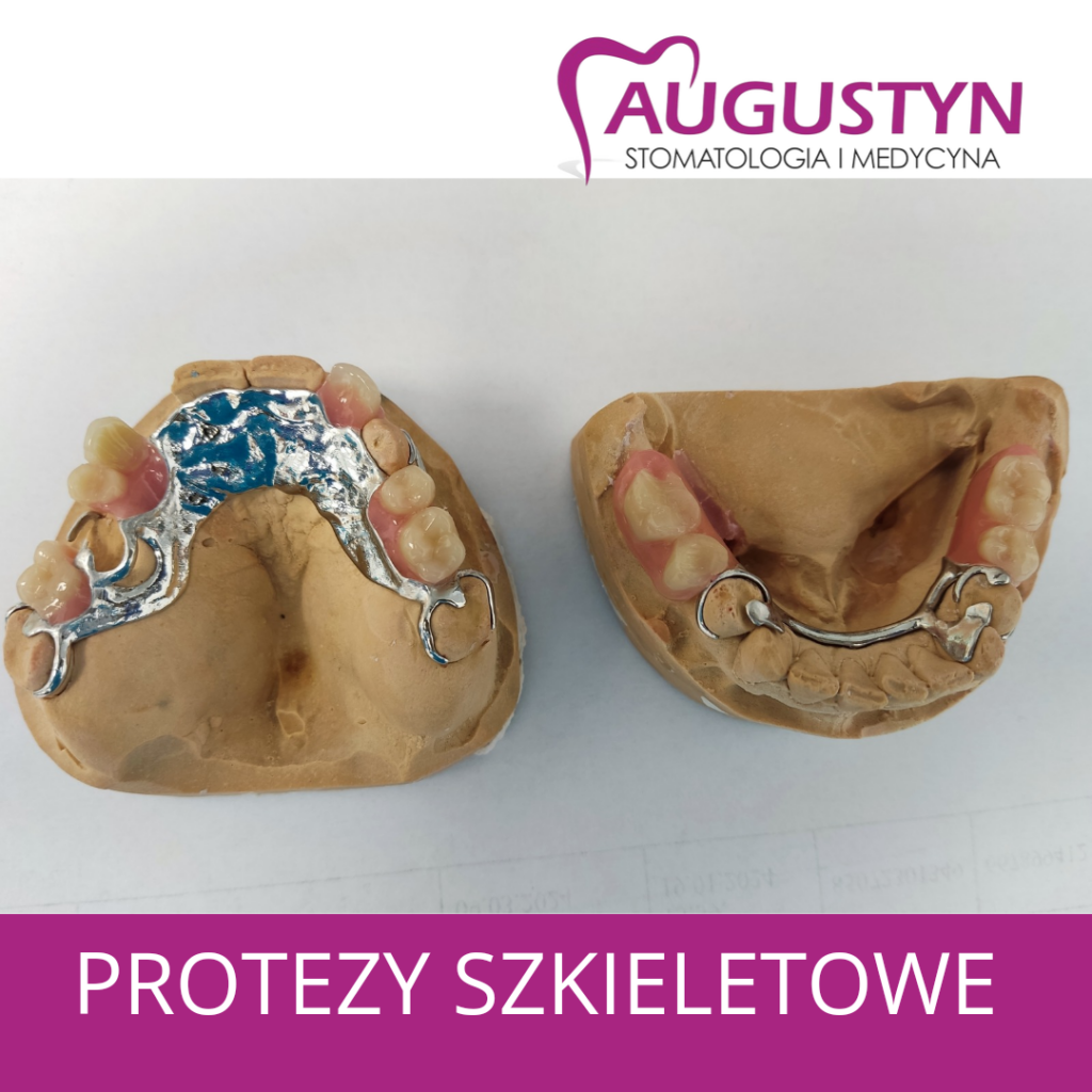 PROTEZY SZKIELETOWE