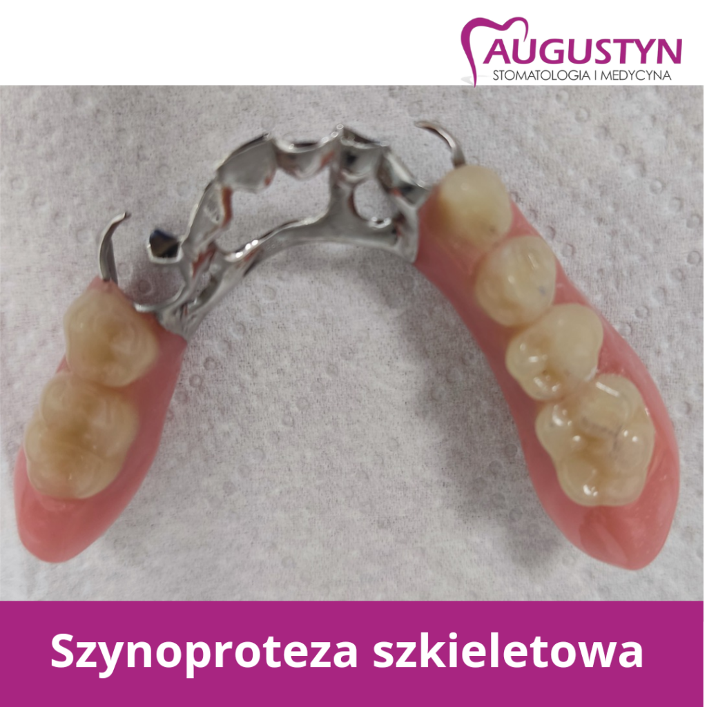 Szynoproteza szkieletowa