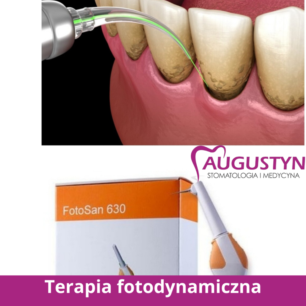 Terapia fotodynamiczna w chorobach przyzębia