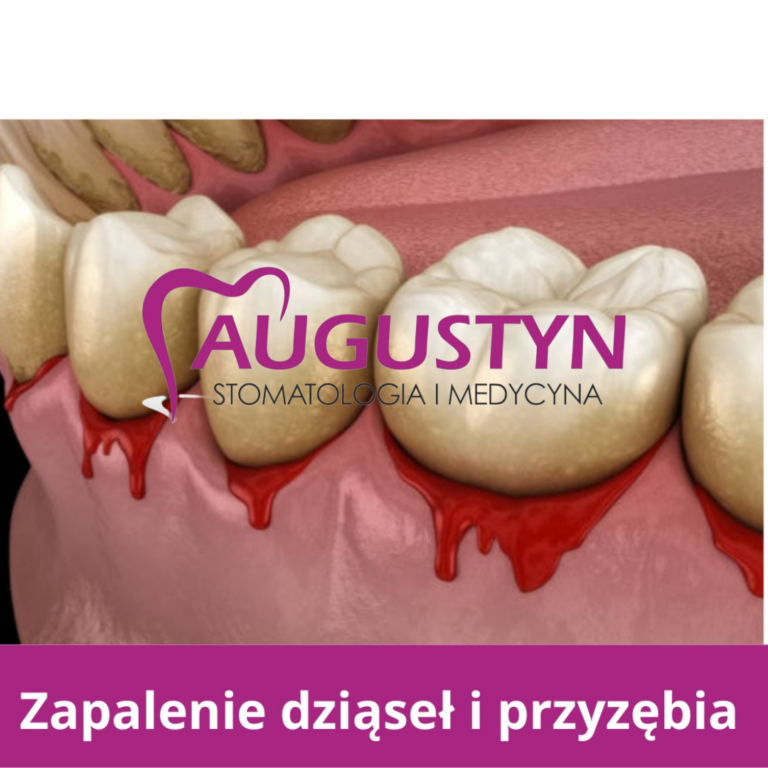 Kamień nazębny – jak powstaje, dlaczego jest niebezpieczny i jak skutecznie się go pozbyć?