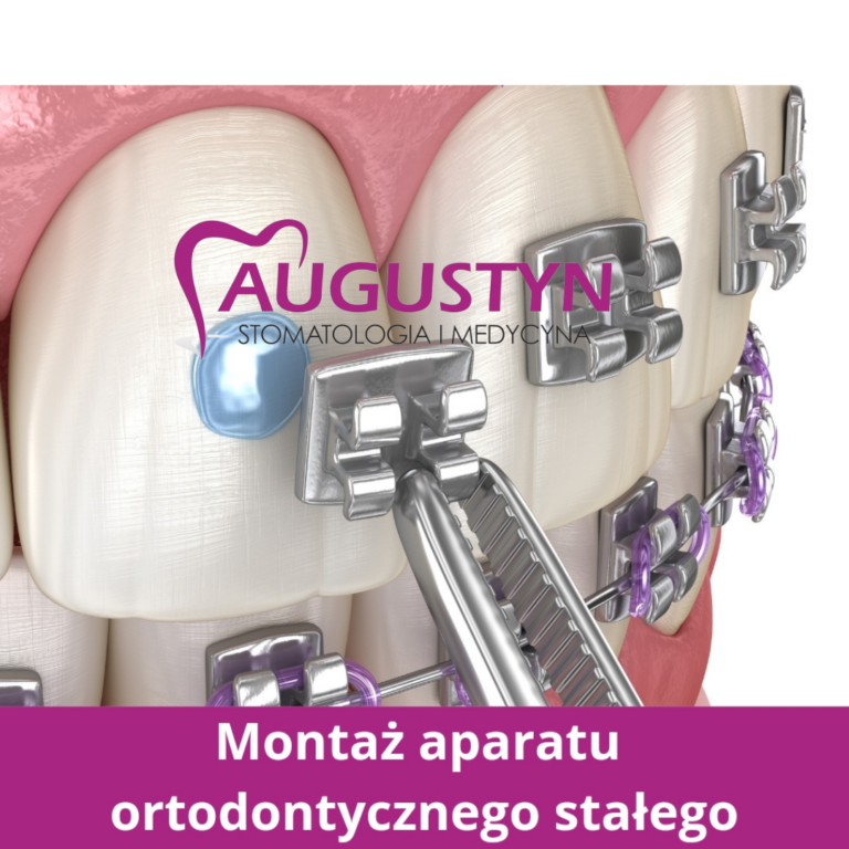 Aparat ortodontyczny? Oto zalecenia, które warto znać!