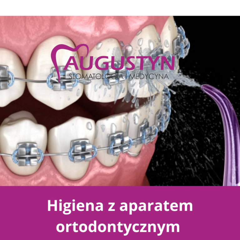 Higiena jamy ustnej przy użytkowaniu aparatu ortodontycznego