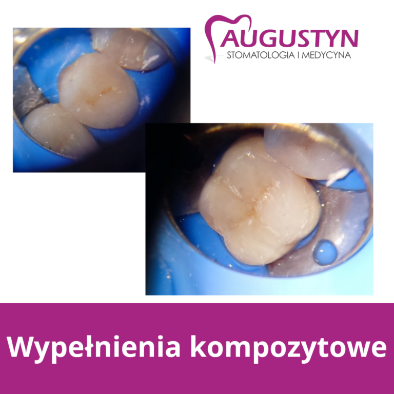 Leczenie zachowawcze w koferdamie – komfort, bezpieczeństwo i precyzja leczenia zębów