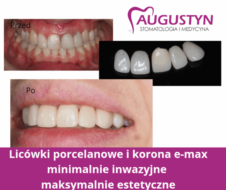 Licówki porcelanowe