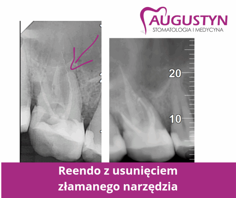 Usunięcie złamanego narzędzia z kanału korzeniowego
