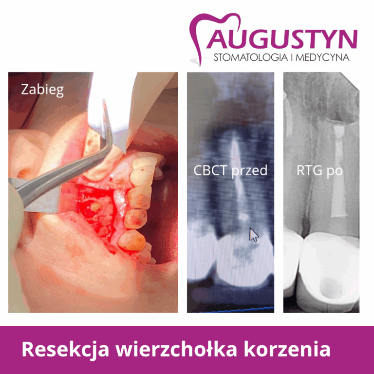 Resekcja wierzchołka korzenia zęba