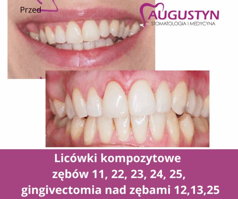 Licówki kompozytowe