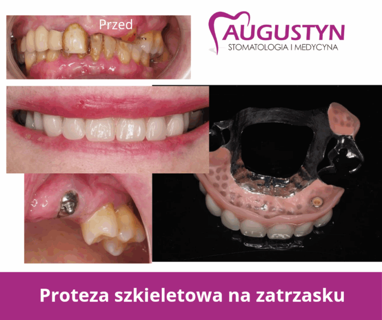 Proteza szkieletowa na zatrzasku