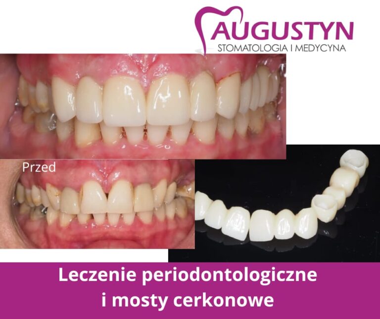 Leczenie periodontologiczne przed protetyką – dlaczego jest tak ważne?