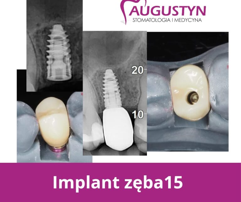 Implant zęba – nowoczesne i trwałe uzupełnienie braków w uzębieniu