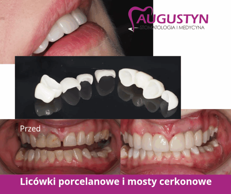 Metamorfoza – licówki porcelanowe i mosty