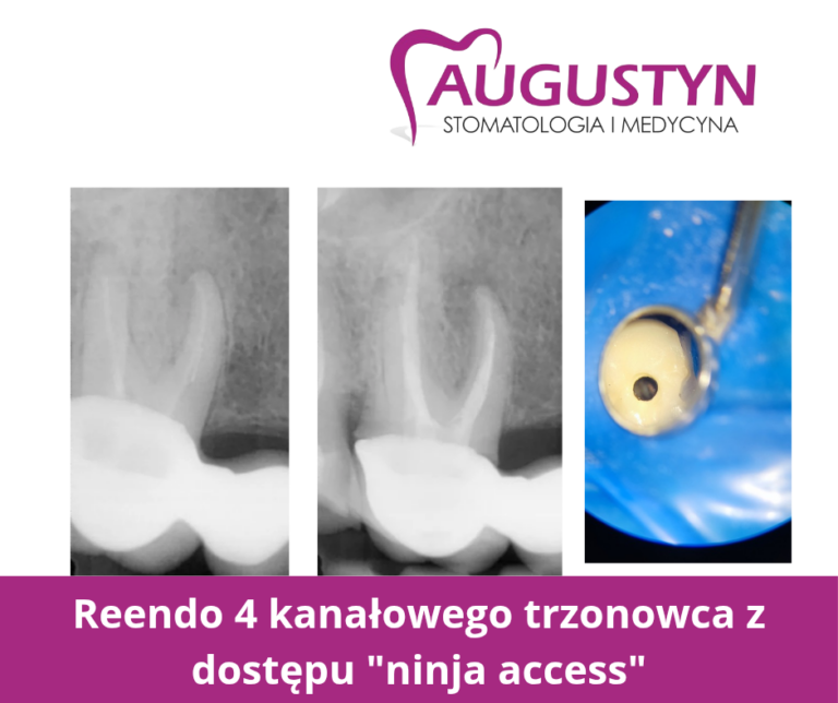 Reendo z dostępu „ninja access”