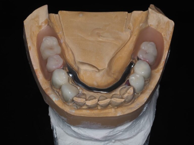Proteza szkieletowa na zasuwach