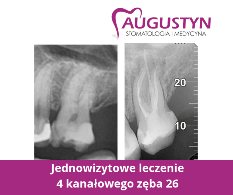 Jednowizytowe leczenie kanałowe