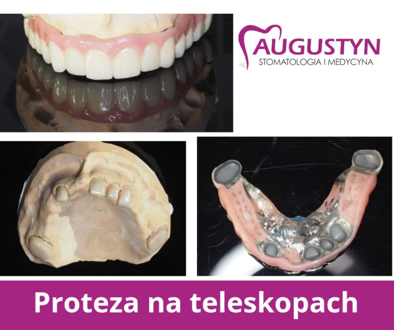 Proteza teleskopowa na zębach własnych – stabilne i komfortowe rozwiązanie protetyczne