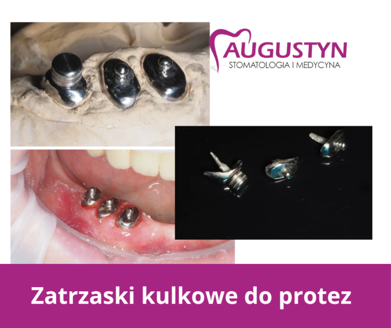 Zatrzaski kulowe na wkładach lanych