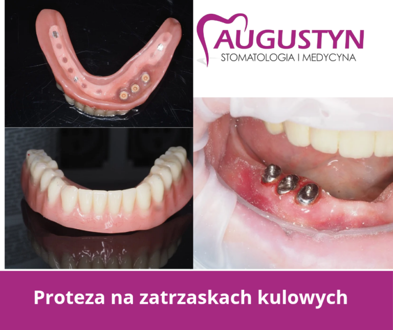 Proteza na zatrzaskach