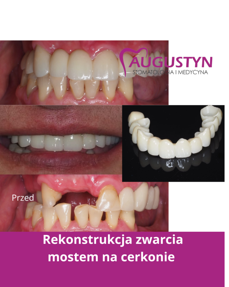 Rekonstrukcja zwarcia mostem cerkonowym