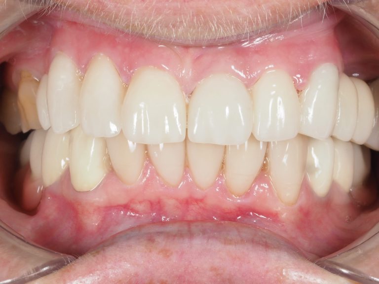 Leczenie kompleksowe periodontologiczno – protetyczne