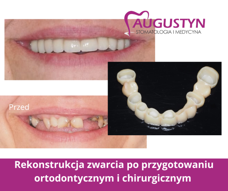 Dlaczego odbudowa braków zębowych jest tak ważna dla prawidłowego funkcjonowania jamy ustnej?